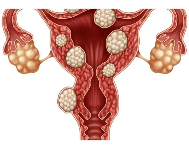 uterine-fibroids-659x519