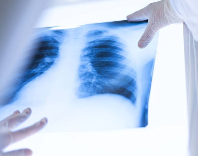 Radiografía de tórax para diagnóstico pulmonar