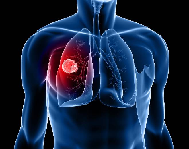 Ilustración de cáncer de pulmón